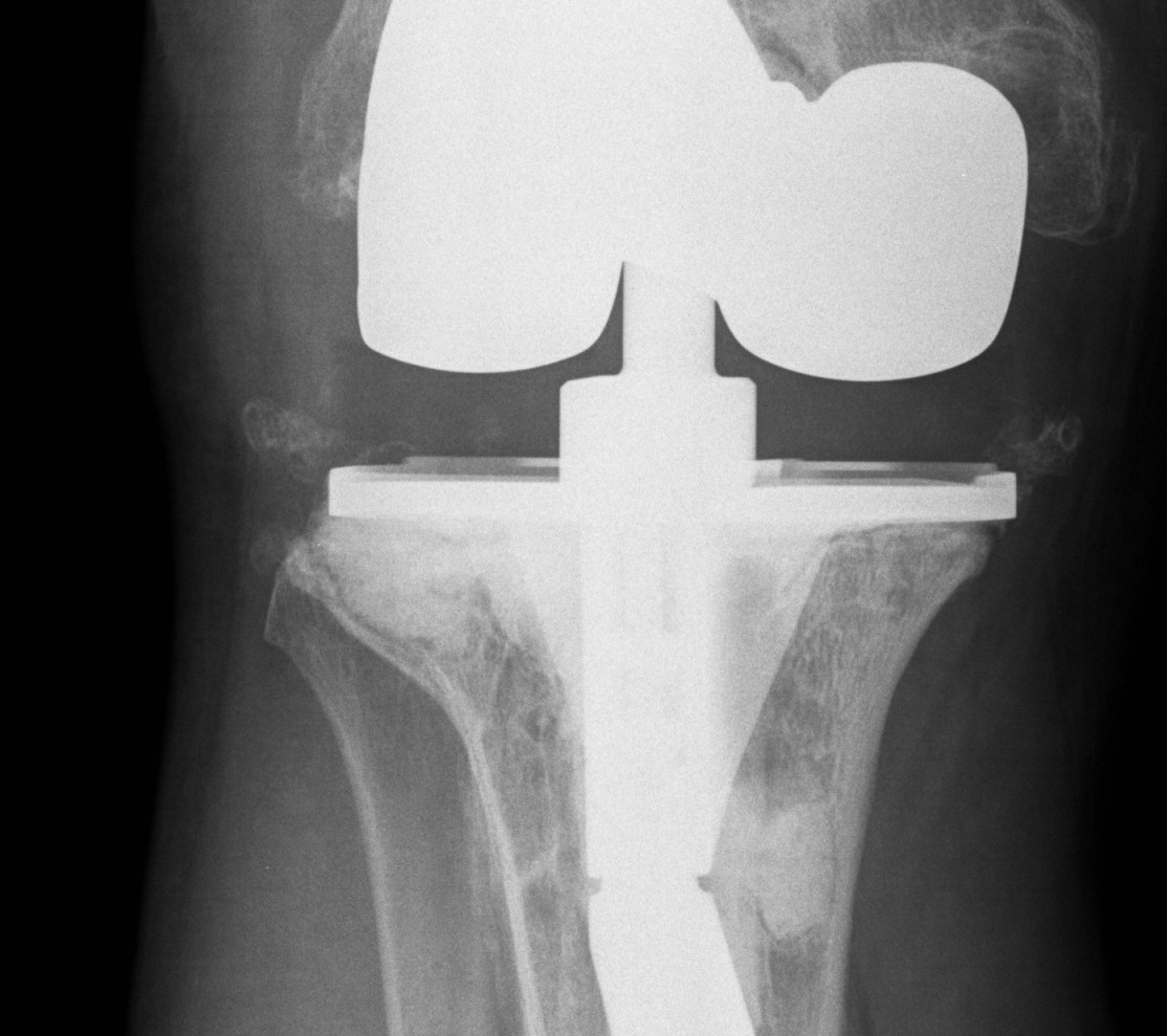 Revision TKR Bone Defect Cement AP